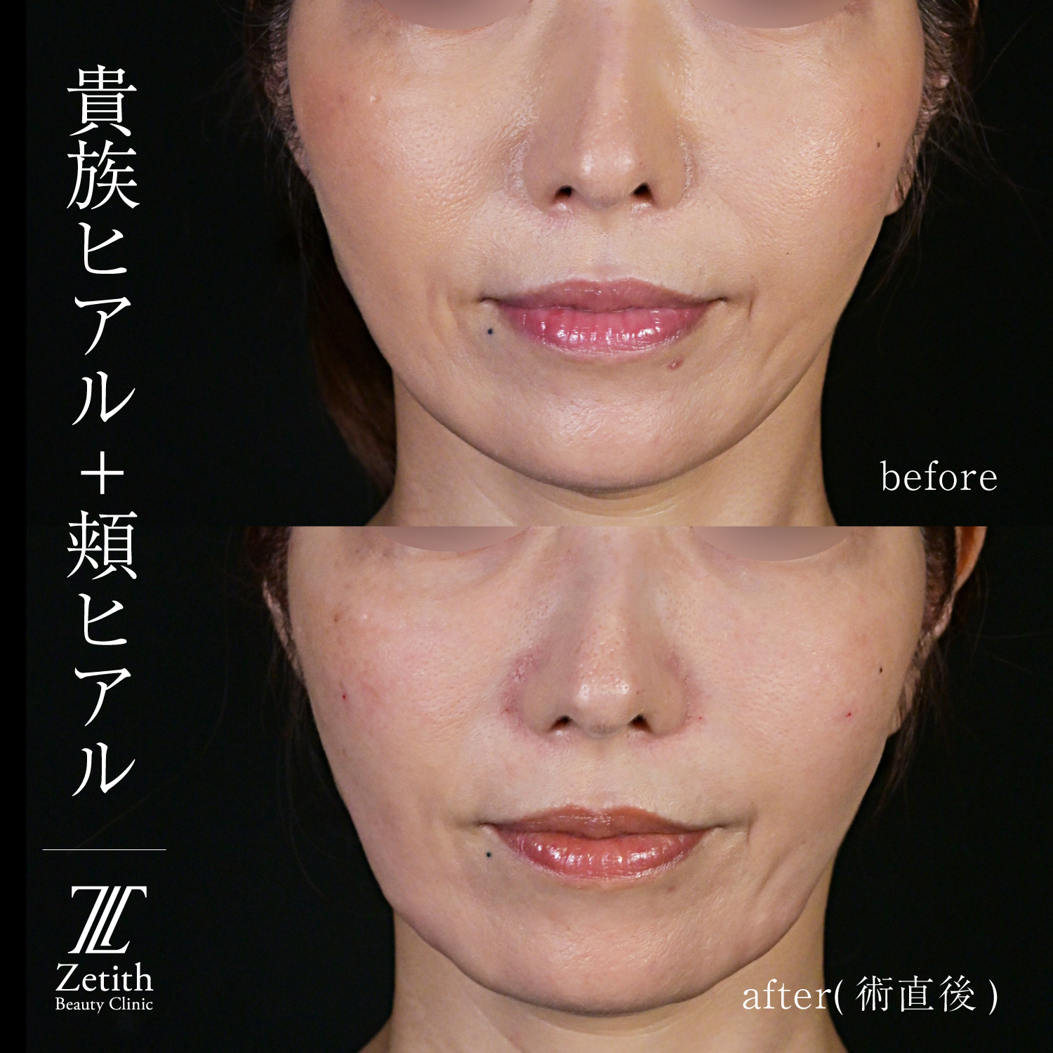 北村医師による脂肪吸引リフトの施術前／施術後1ヶ月