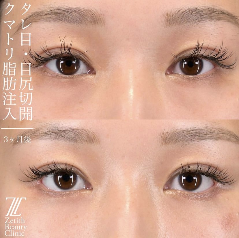 上木原医師による目元整形の施術前／施術後3ヶ月