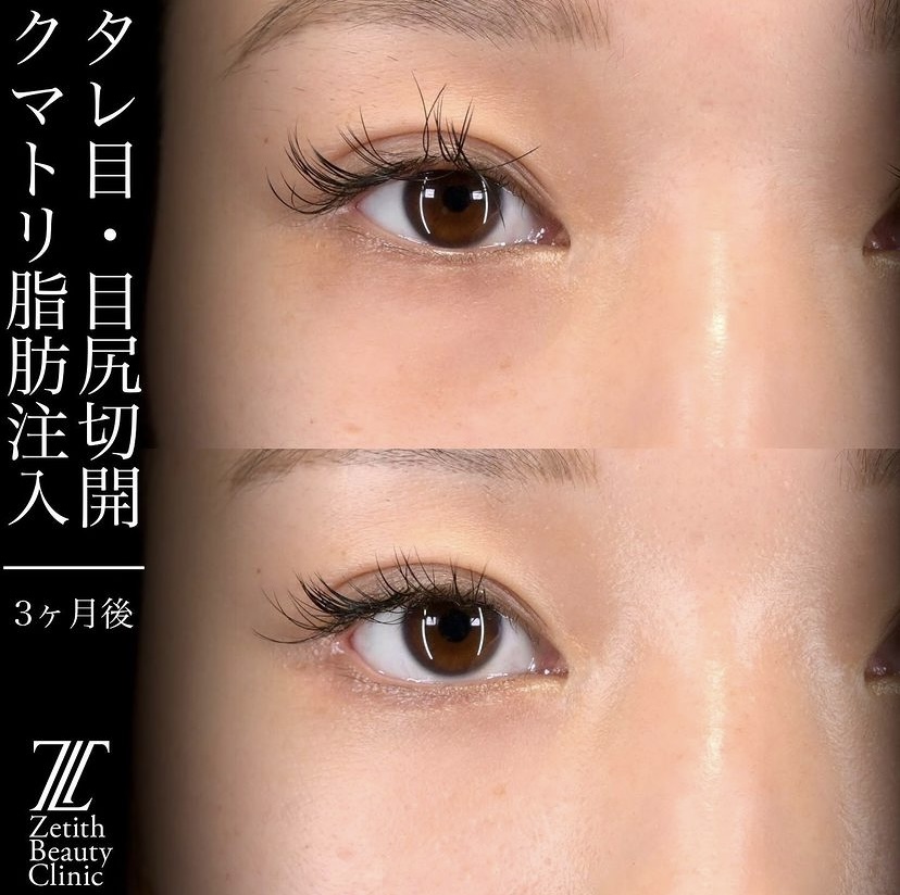 上木原医師による目元整形の施術前／施術後3ヶ月 Sau 