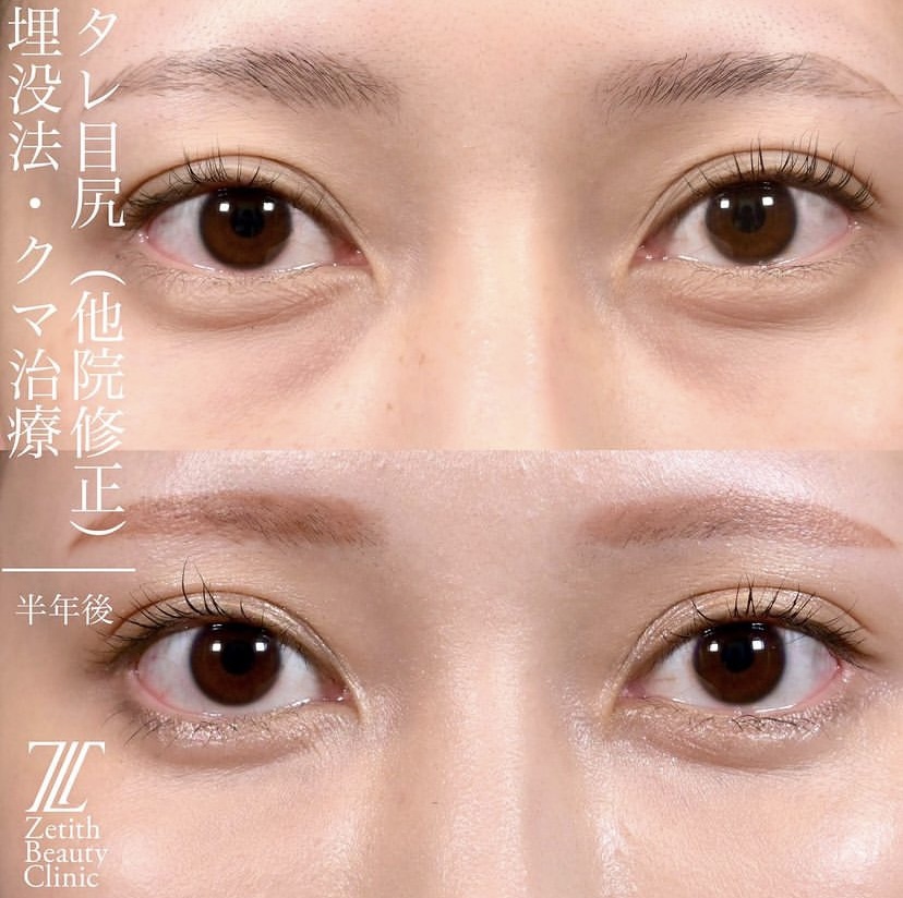 上木原医師による目元整形の施術前／施術後6ヶ月