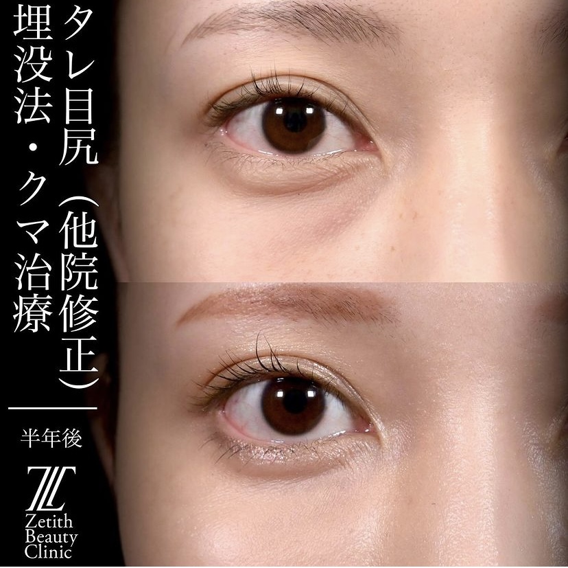 上木原医師による目元整形の施術前／施術後6ヶ月 Sonra 
