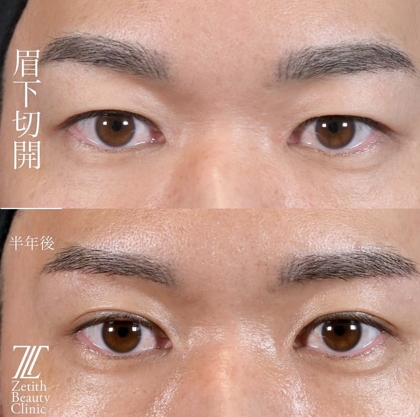 上木原医師による目元整形の施術前／施術後6ヶ月