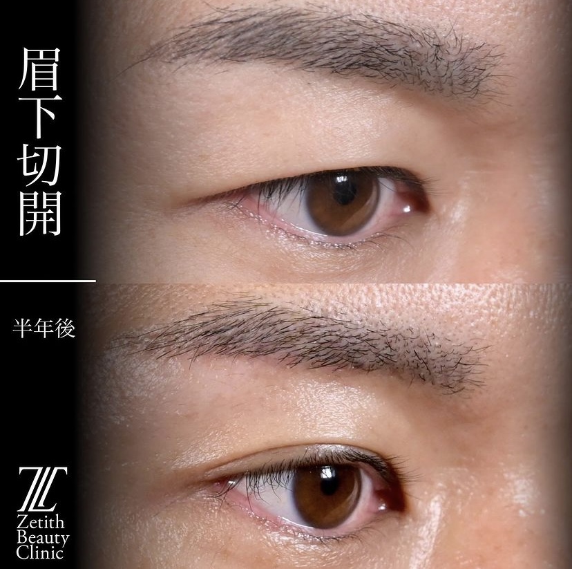 上木原医師による目元整形の施術前／施術後6ヶ月 Sonra 