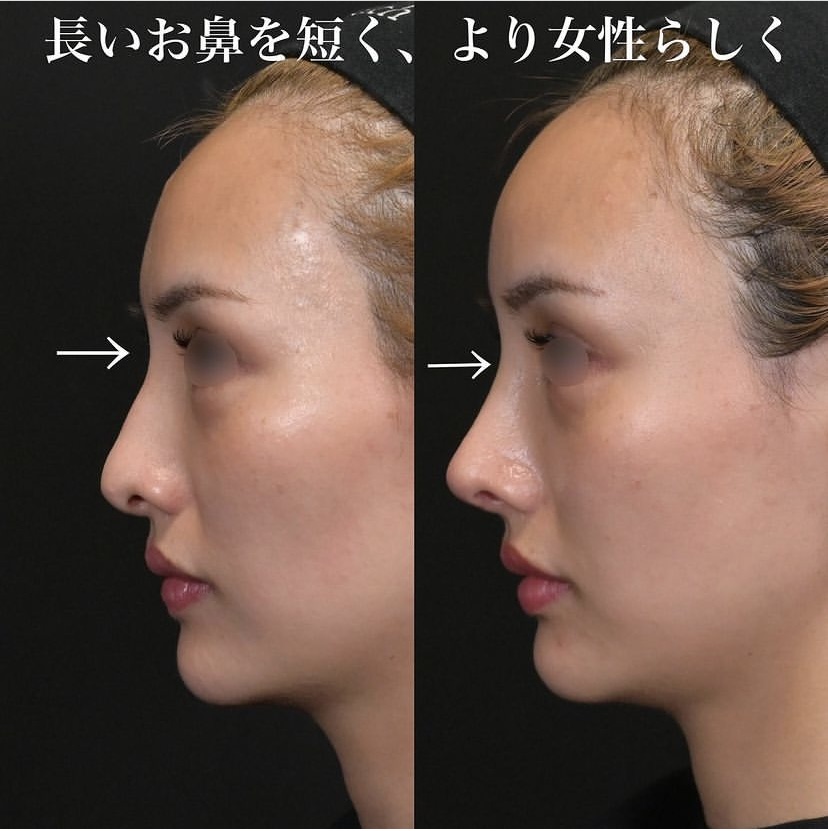 鉄医師による鼻整形の施術前／施術後1ヶ月