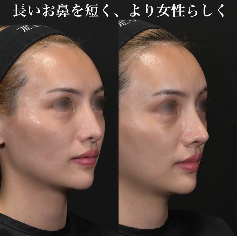 鉄医師による鼻整形の施術前／施術後1ヶ月 施術後 