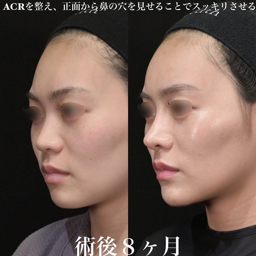 鉄医師による鼻整形の施術前／施術後8ヶ月 หลัง 
