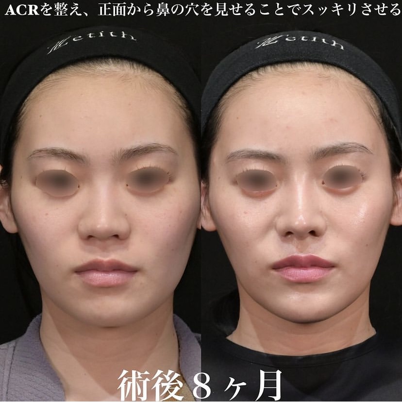 鉄医師による鼻整形の施術前／施術後8ヶ月