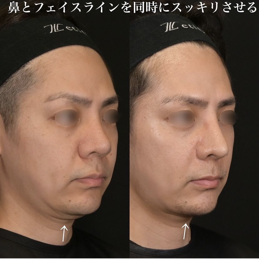 鉄医師による鼻整形の施術前／施術後2週間