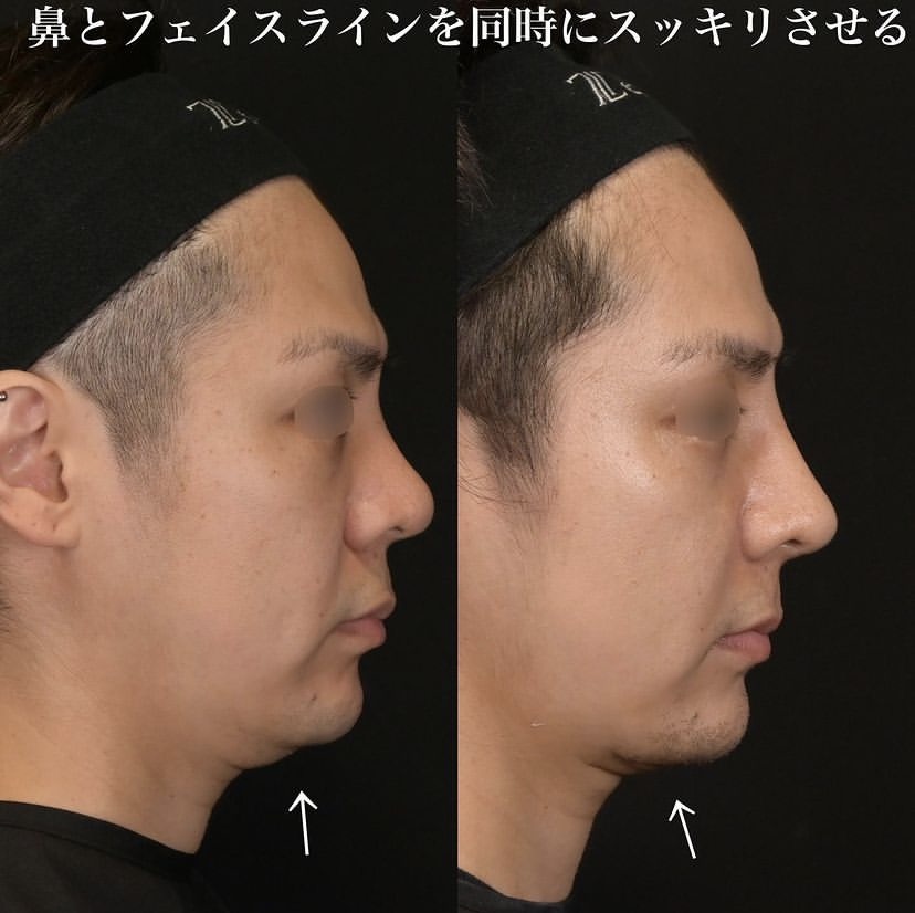 鉄医師による鼻整形の施術前／施術後2週間 After 
