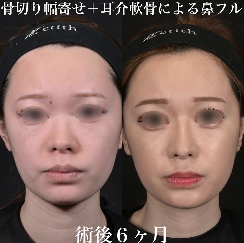 鉄医師による鼻整形の施術前／施術後6ヶ月