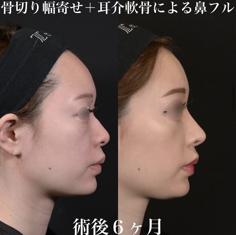 鉄医師による鼻整形の施術前／施術後6ヶ月 施術後 
