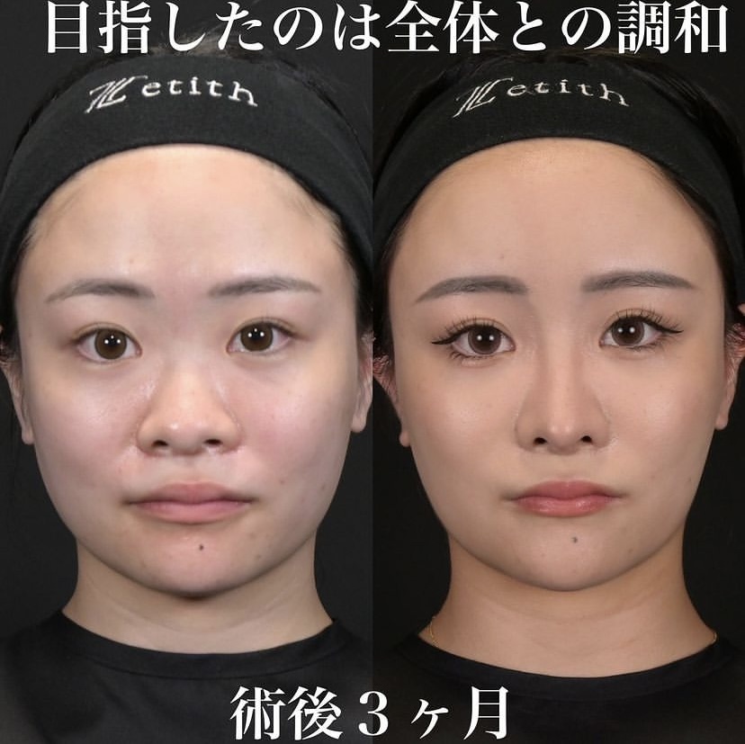 鉄医師による鼻整形の施術前／施術後3ヶ月