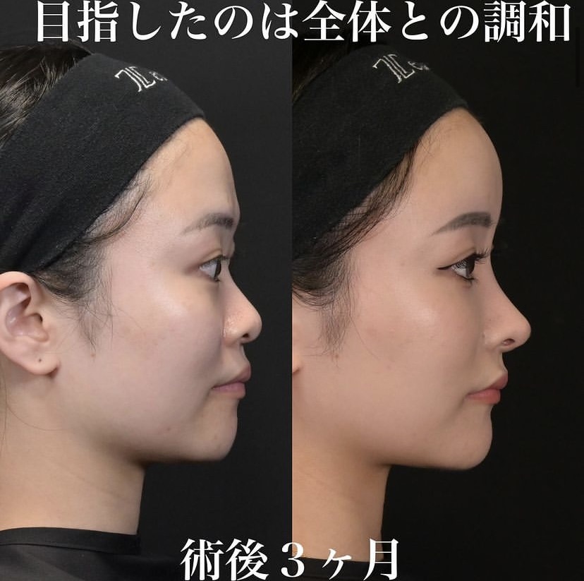 鉄医師による鼻整形の施術前／施術後3ヶ月 施術後 