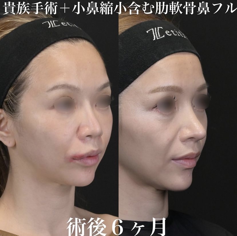 鉄医師による鼻整形の施術前／施術後6ヶ月