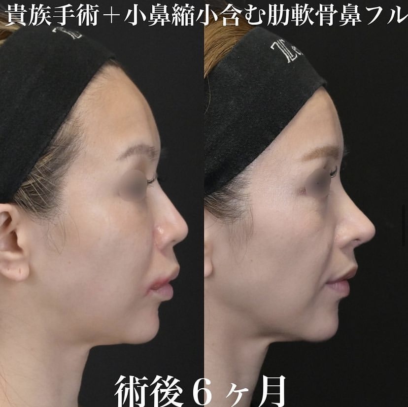 鉄医師による鼻整形の施術前／施術後6ヶ月 施術後 