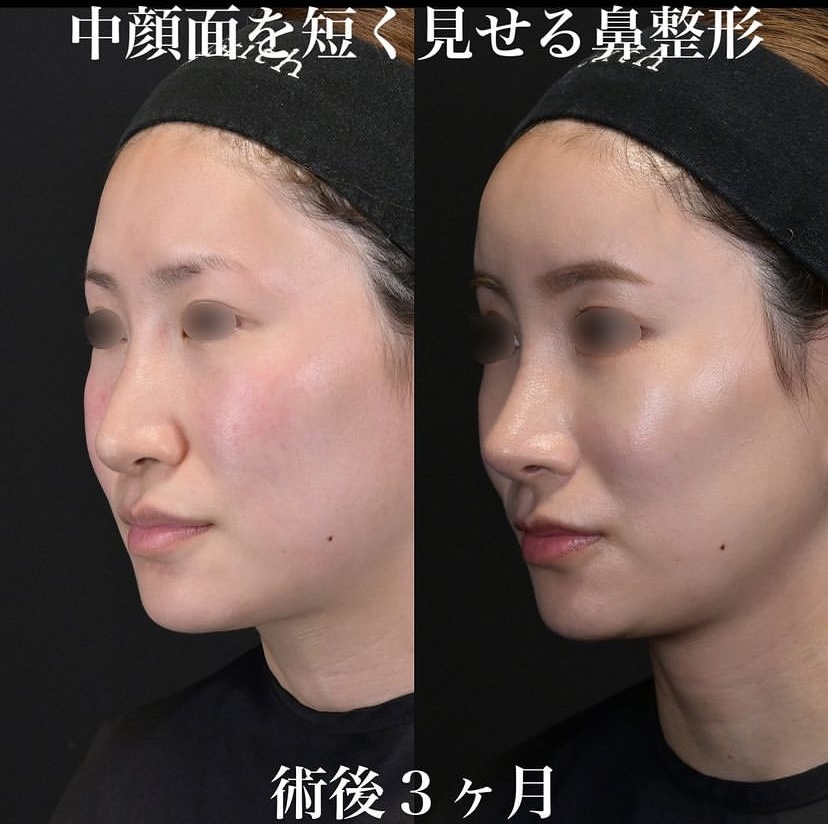 鉄医師による鼻整形の施術前／施術後3ヶ月