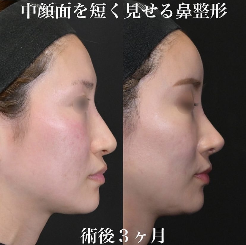 鉄医師による鼻整形の施術前／施術後3ヶ月 术后 