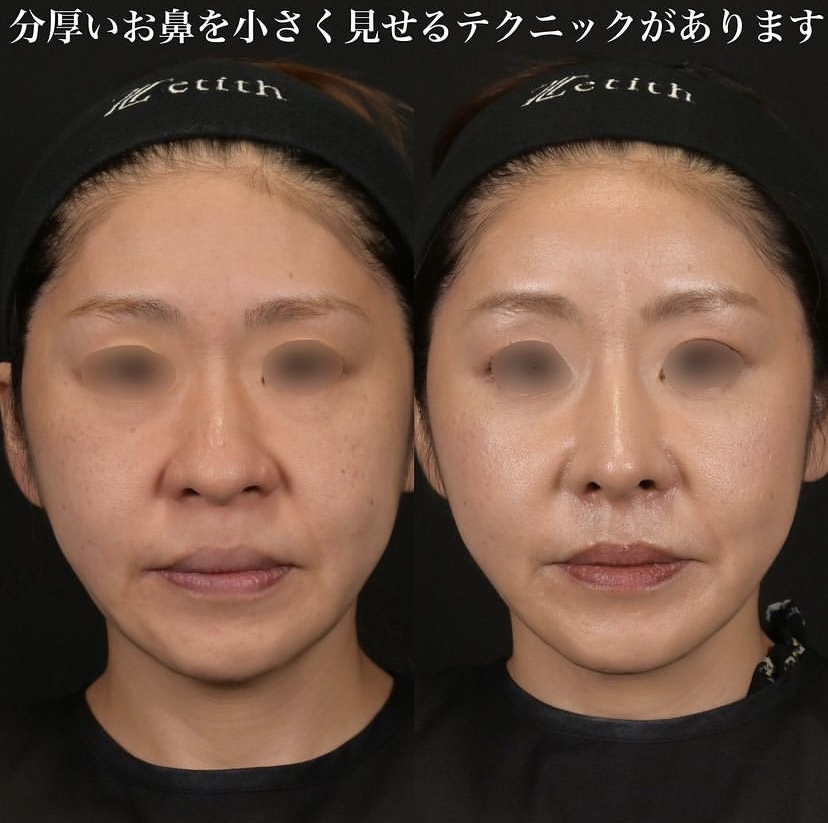 鉄医師による鼻整形の施術前／施術後1ヶ月