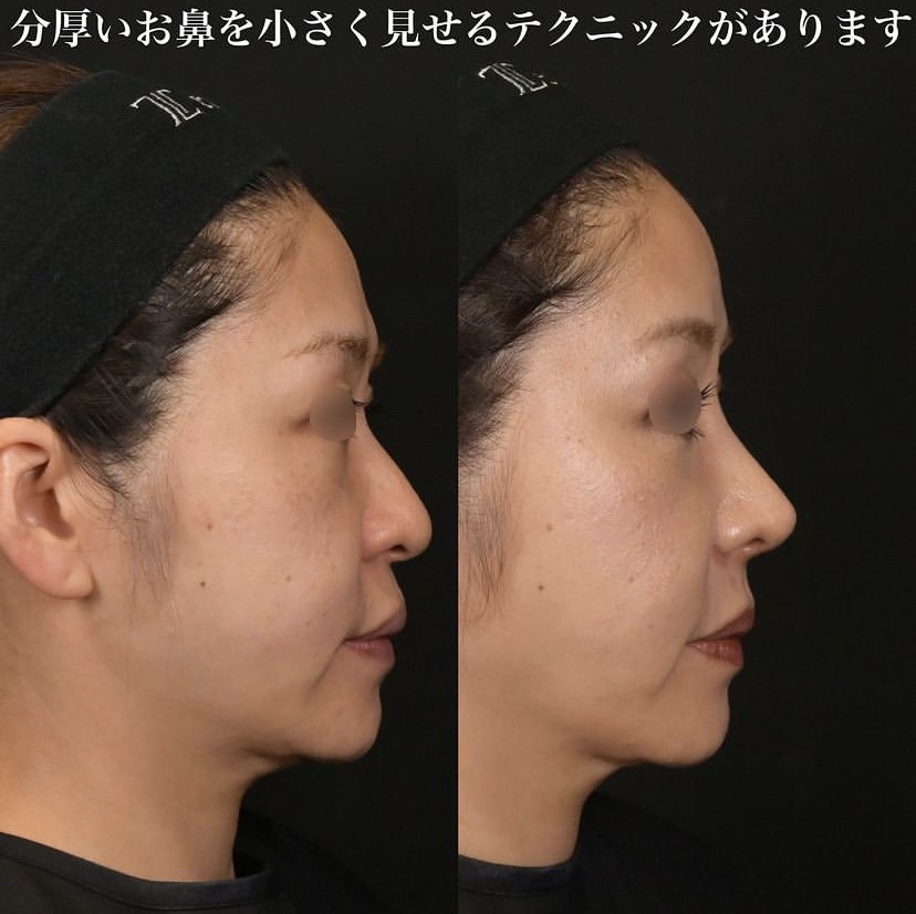 鉄医師による鼻整形の施術前／施術後1ヶ月 Дараа 