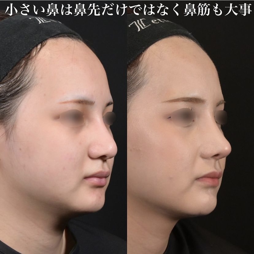 鉄医師による鼻整形の施術前／施術後4ヶ月 施術後 
