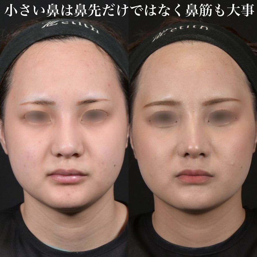 鉄医師による鼻整形の施術前／施術後4ヶ月