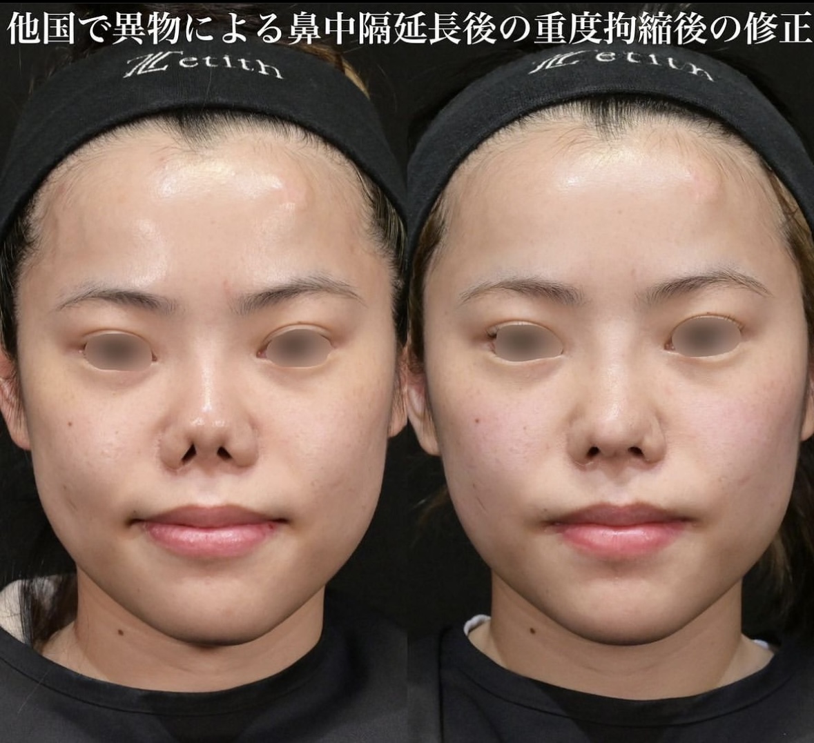 鉄医師による鼻整形の施術前／施術後1ヶ月