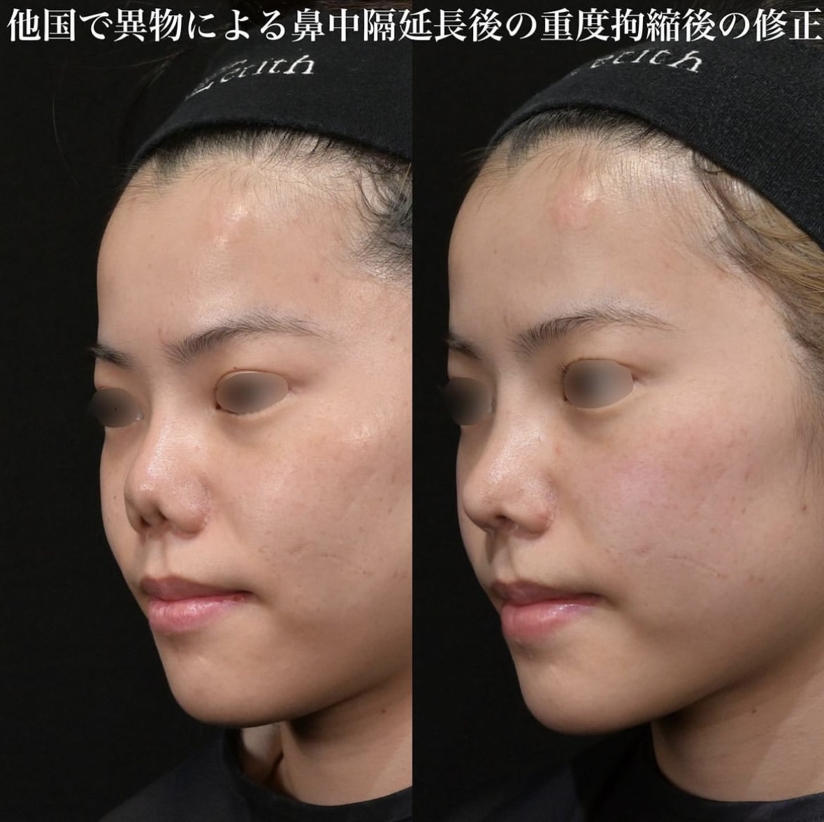 鉄医師による鼻整形の施術前／施術後1ヶ月 施術後 