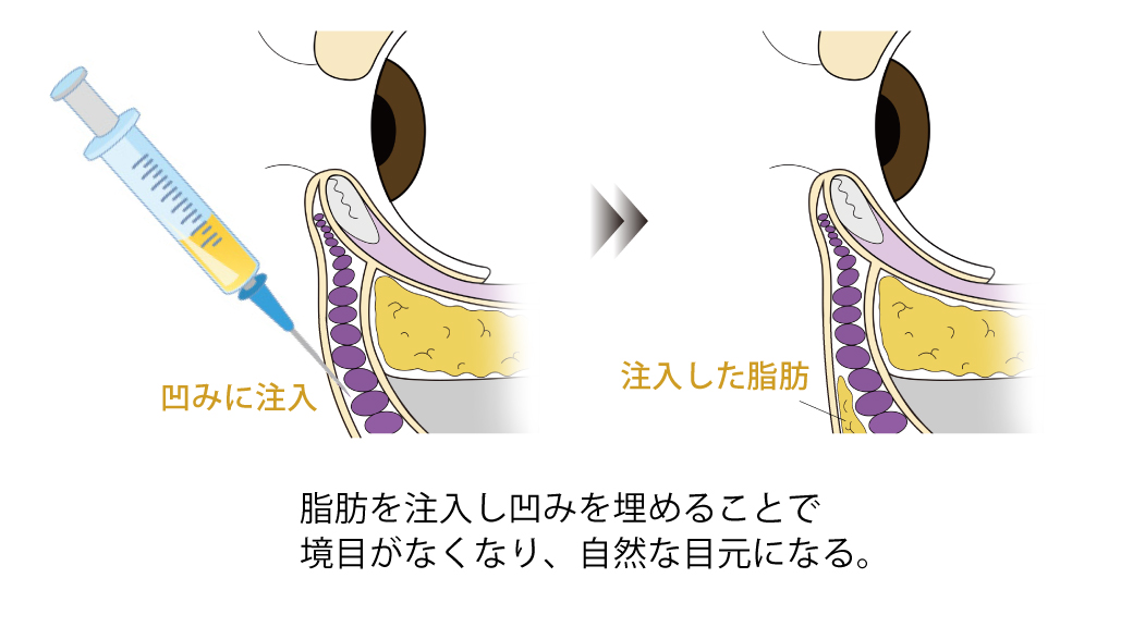 脂肪注入でより自然に