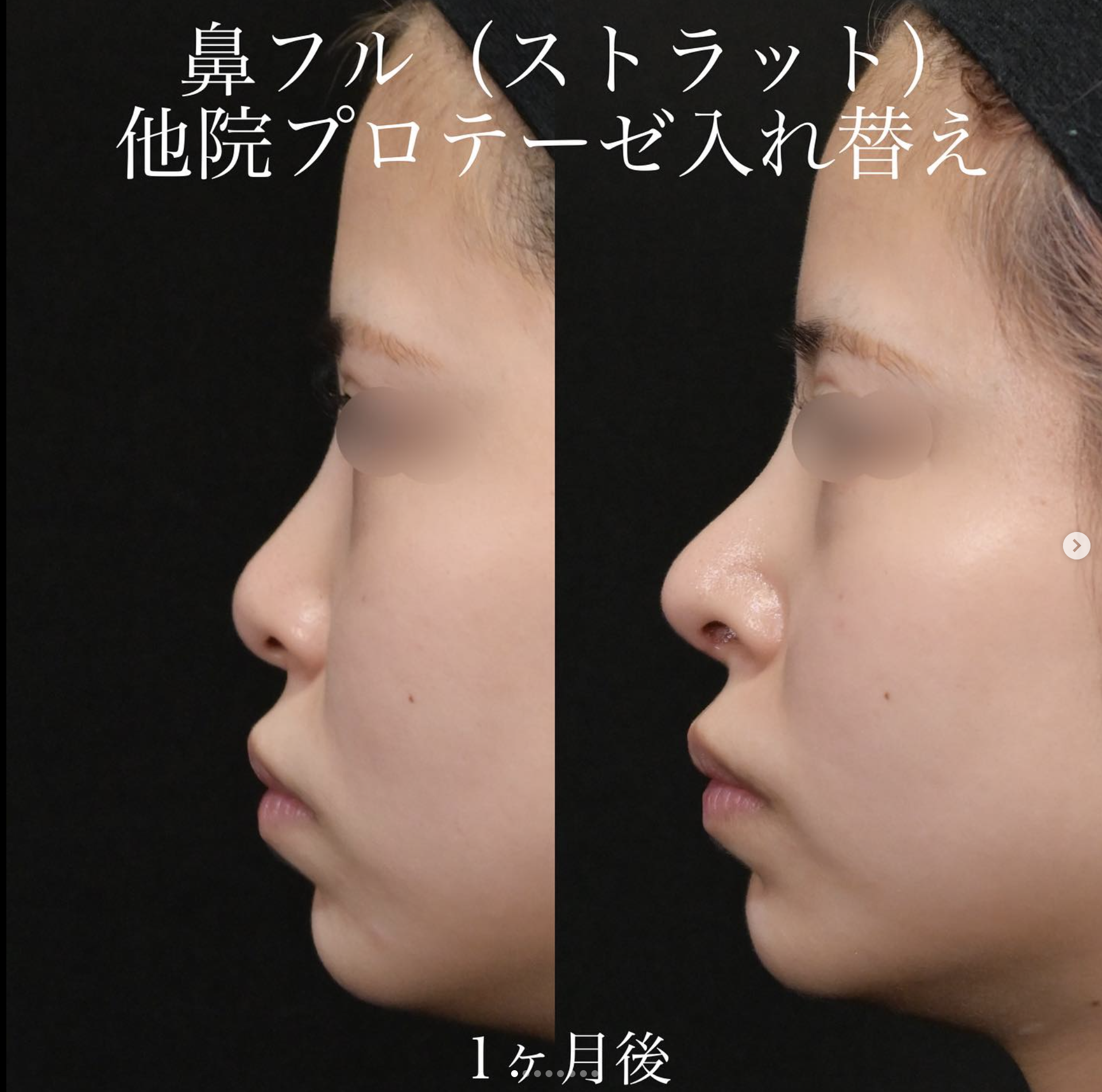 上木原医師による鼻整形の施術前／施術後1ヶ月