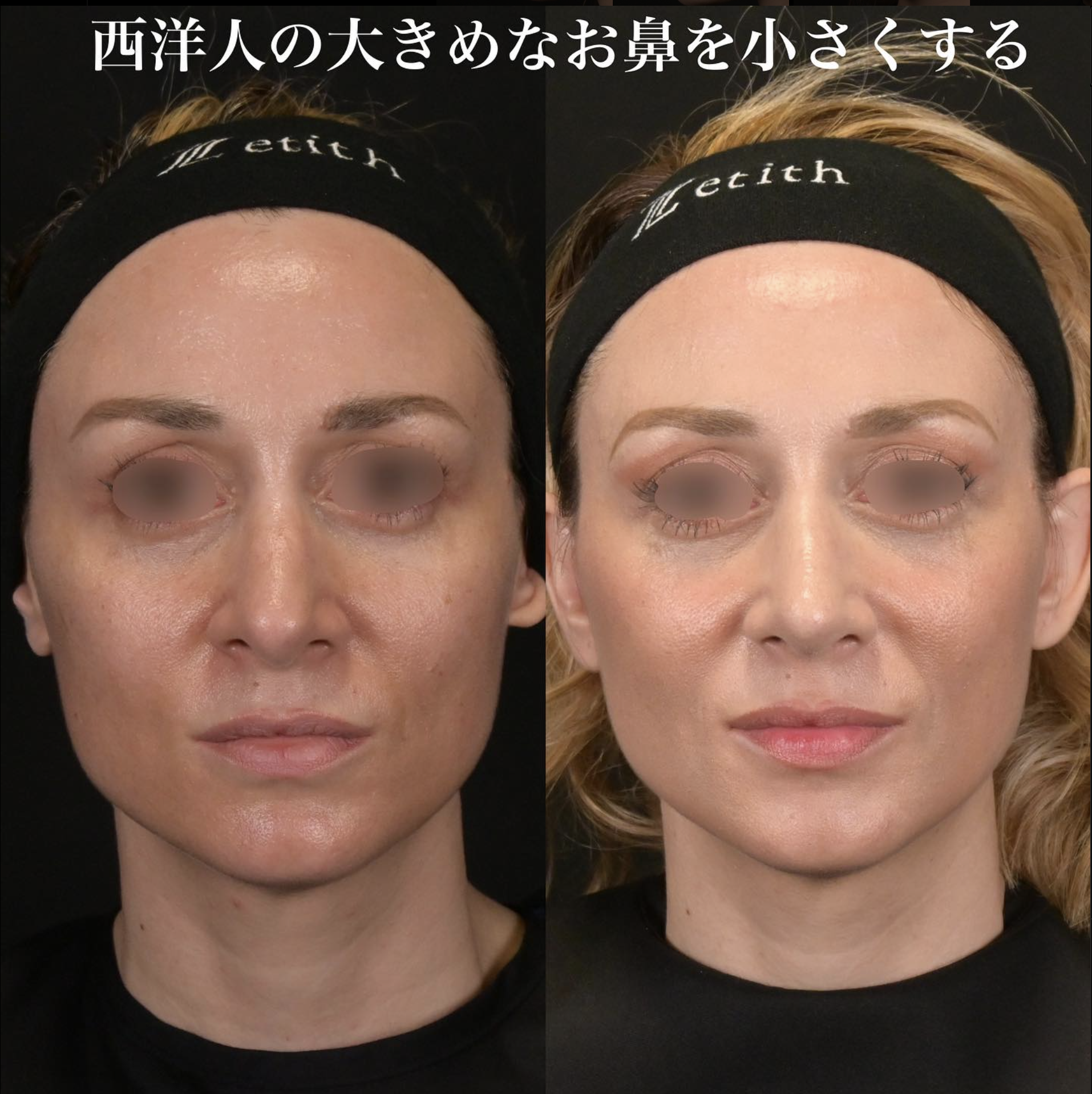 鉄医師による鼻整形の施術前／施術後1ヶ月 After 