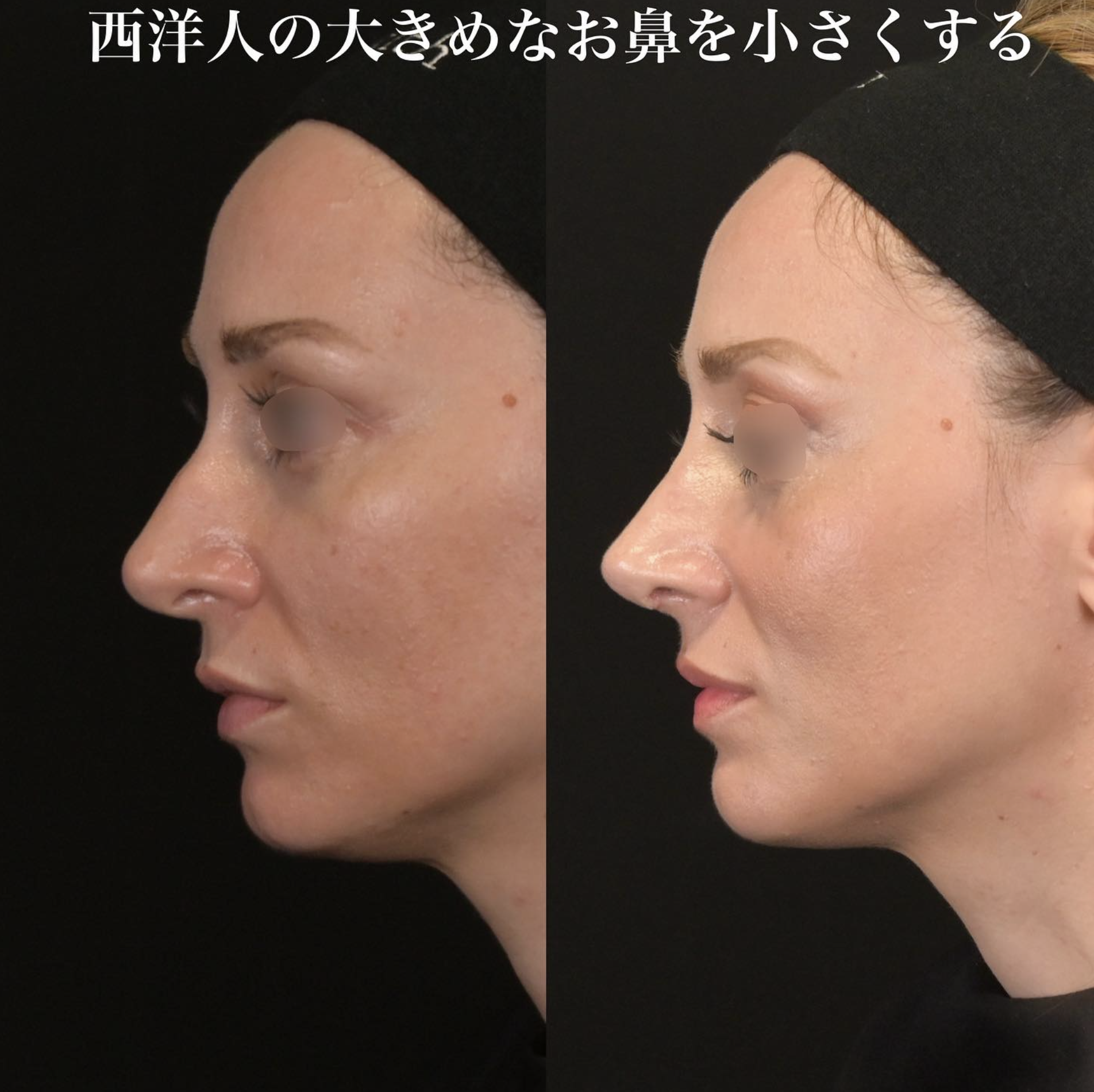 鉄医師による鼻整形の施術前／施術後1ヶ月