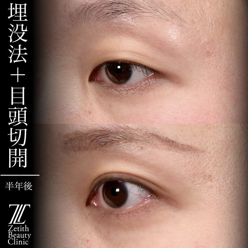 上木原医師による目元整形の施術前／施術後6ヶ月 After 