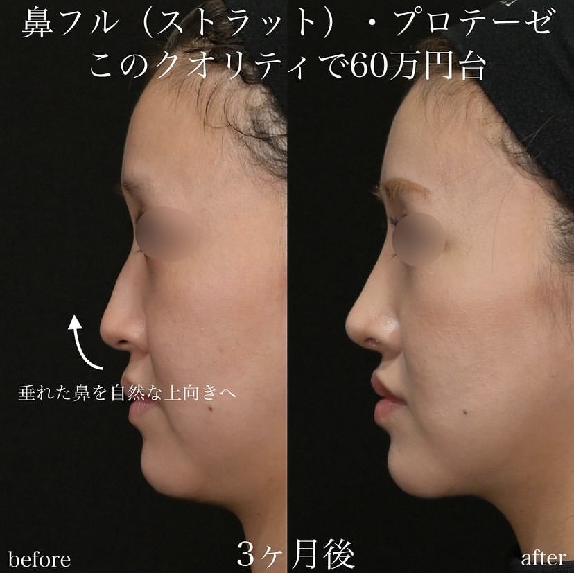 上木原医師による鼻整形の施術前／施術後3ヶ月 施術後 