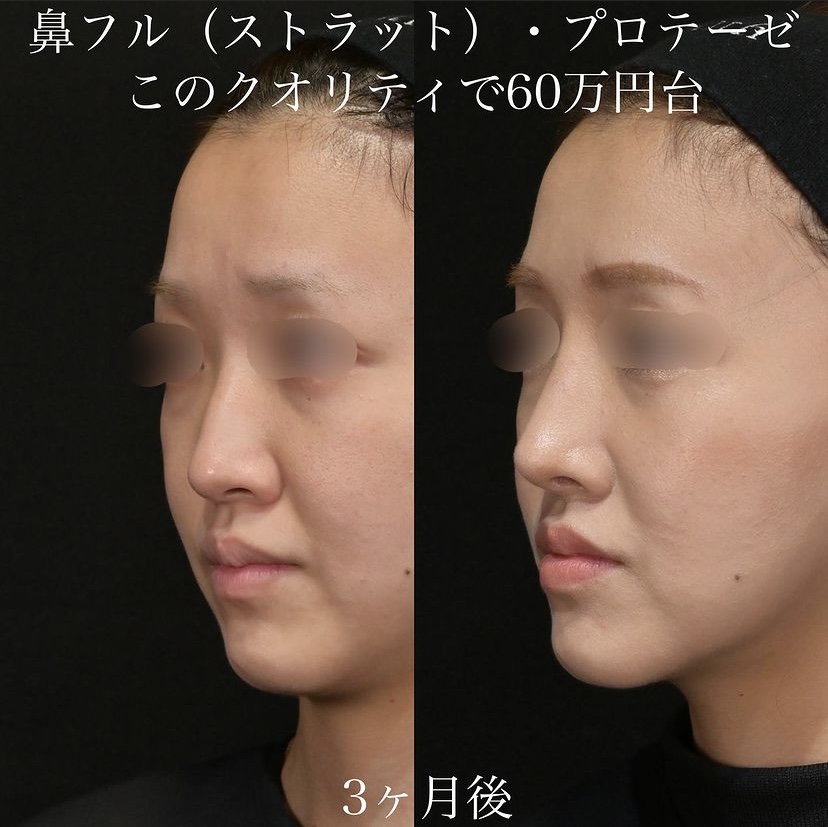 上木原医師による鼻整形の施術前／施術後3ヶ月