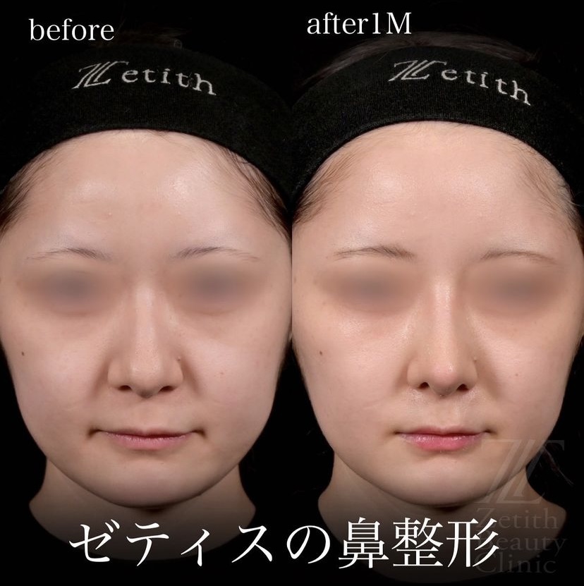 守屋医師による鼻整形の施術前／施術後1ヶ月