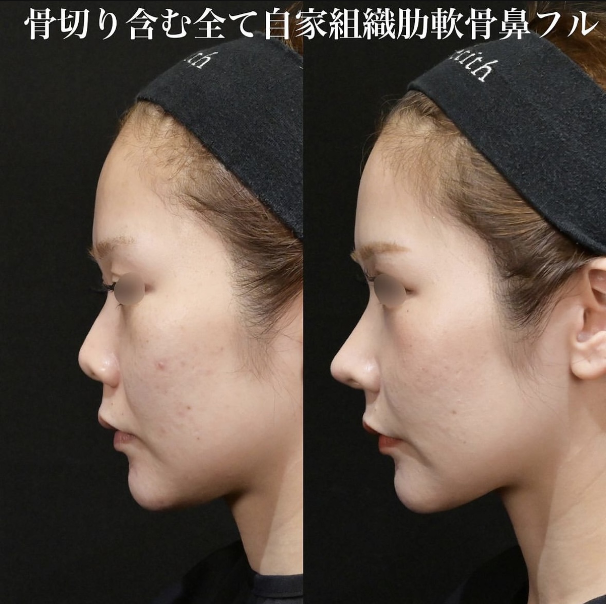 鉄医師による鼻整形の施術前／施術後3ヶ月