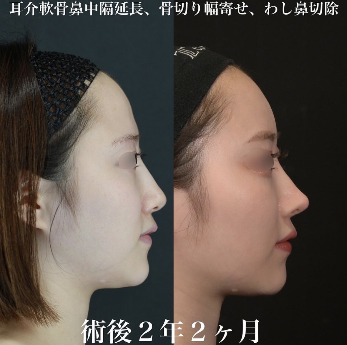 鉄医師による鼻整形の施術前／施術後2年2ヶ月