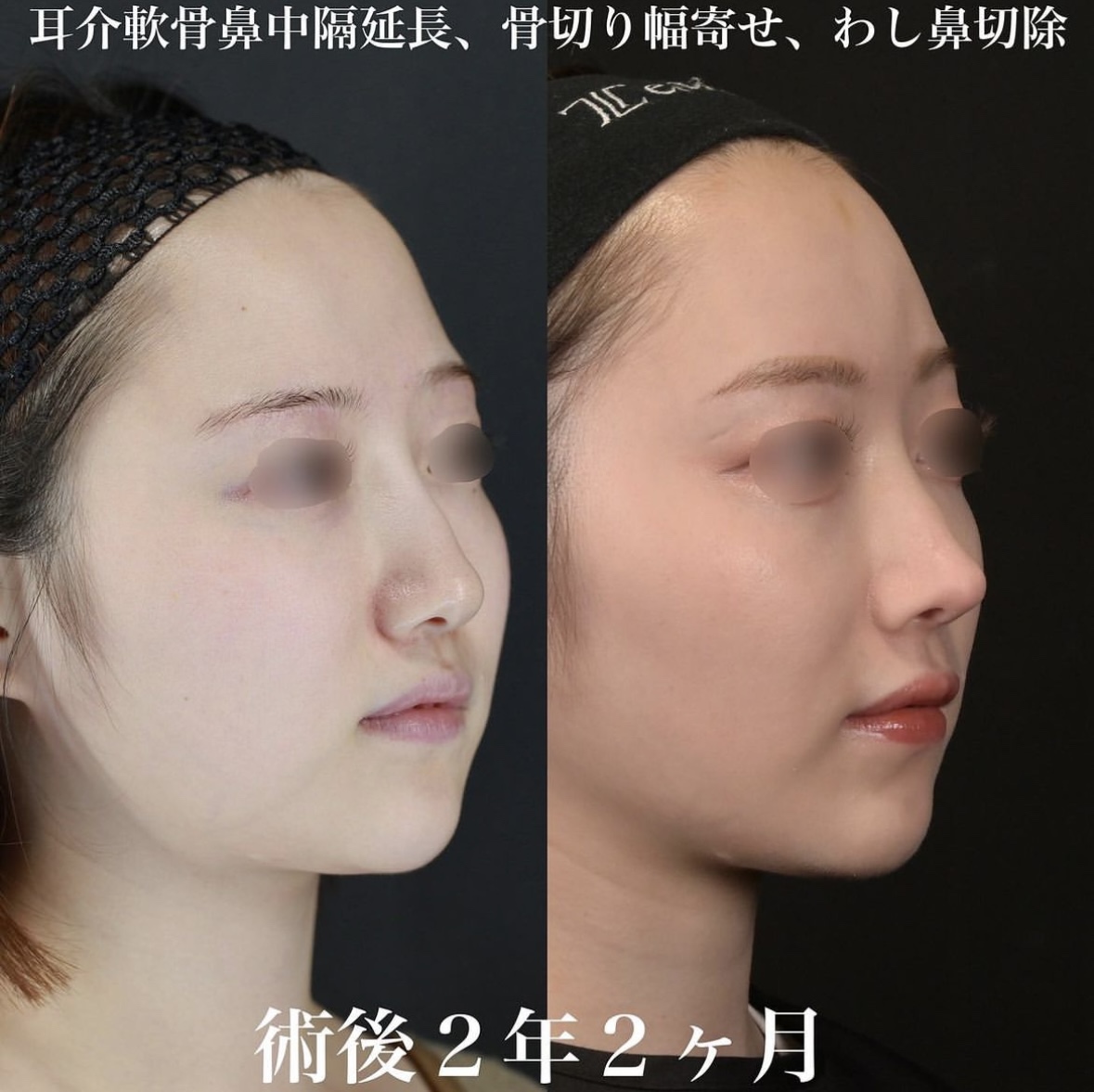 鉄医師による鼻整形の施術前／施術後2年2ヶ月 施術後 