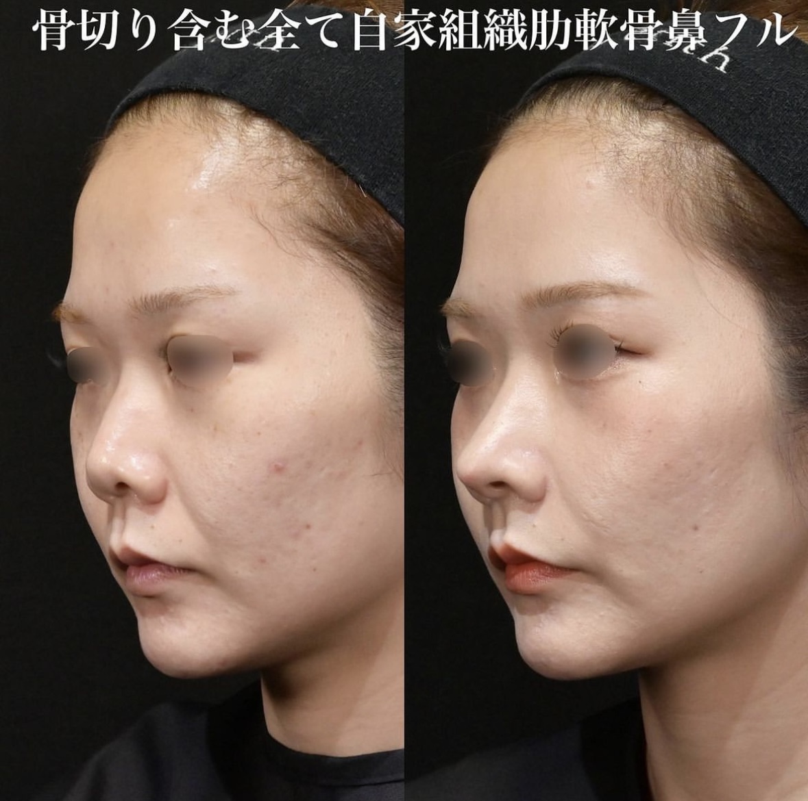 鉄医師による鼻整形の施術前／施術後3ヶ月 After 
