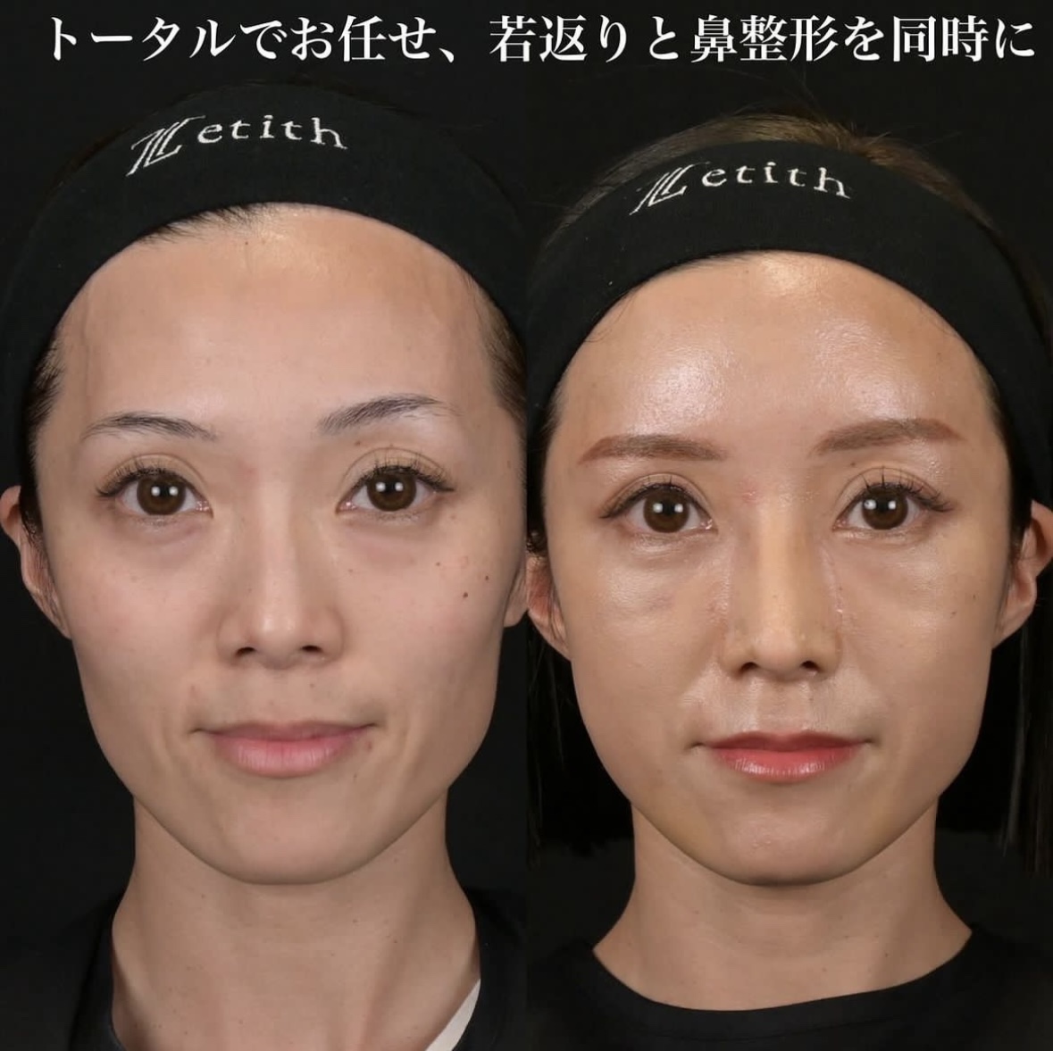 鉄医師による鼻整形の施術前／施術後2週間