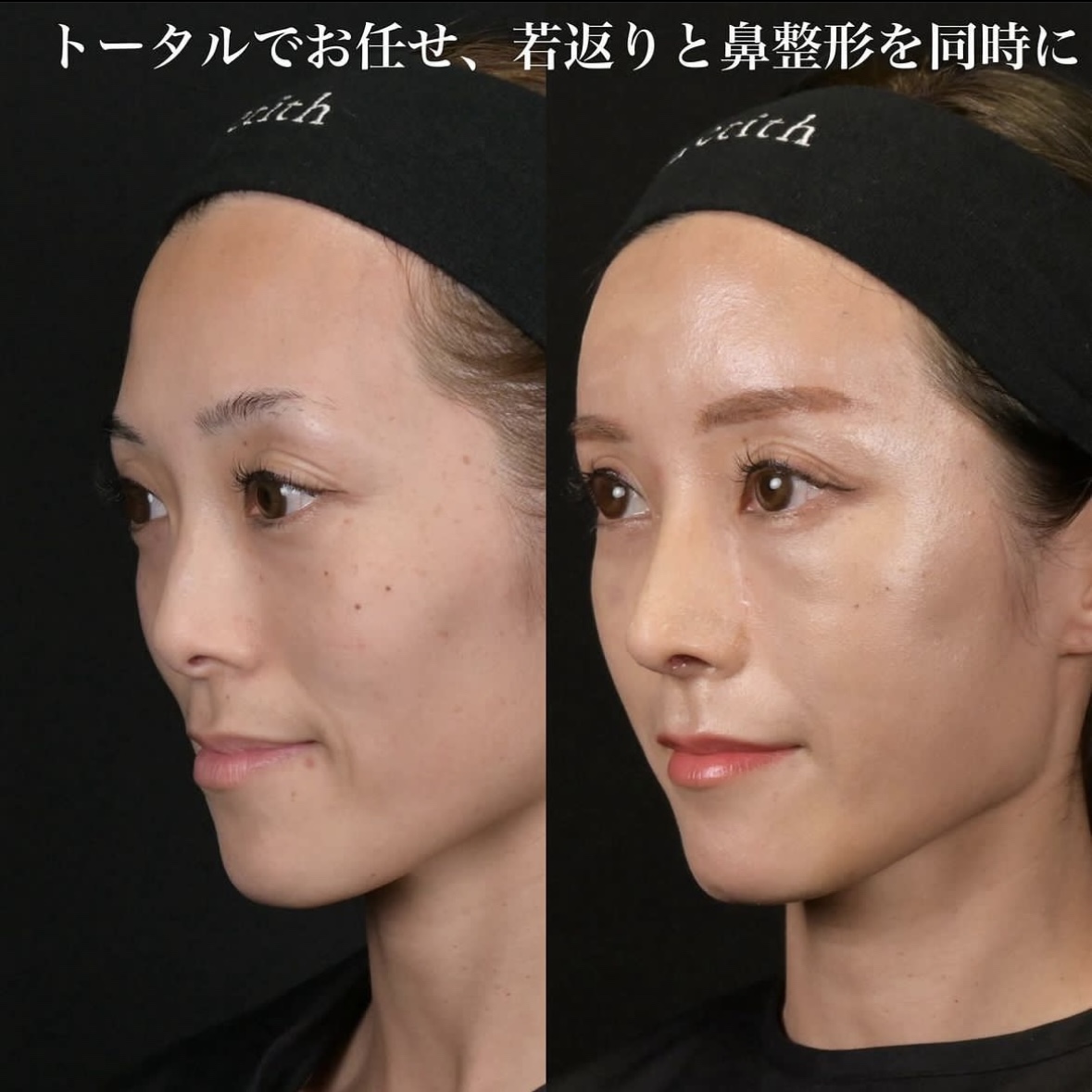 鉄医師による鼻整形の施術前／施術後2週間 หลัง 
