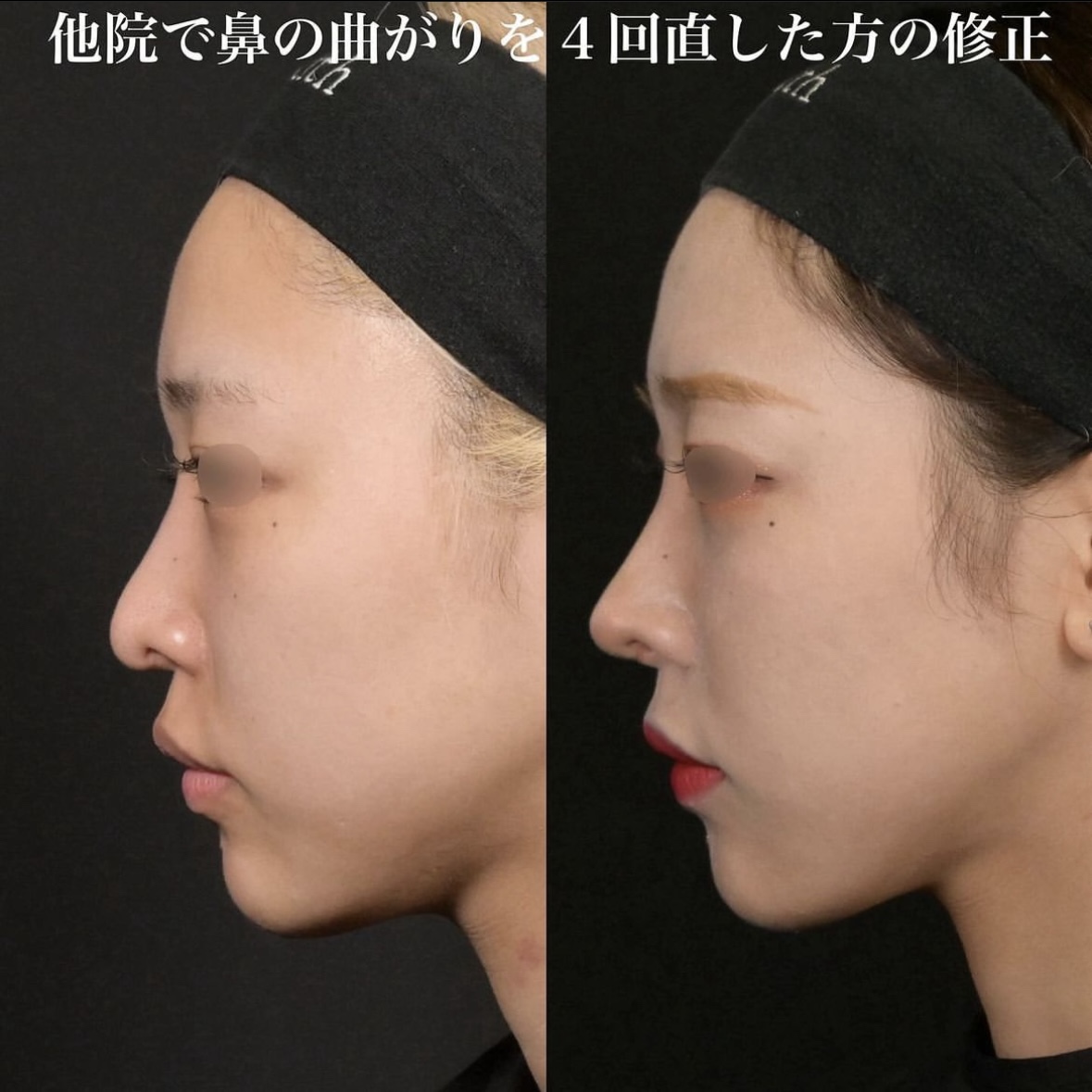 鉄医師による鼻整形の施術前／施術後3ヶ月 Дараа 