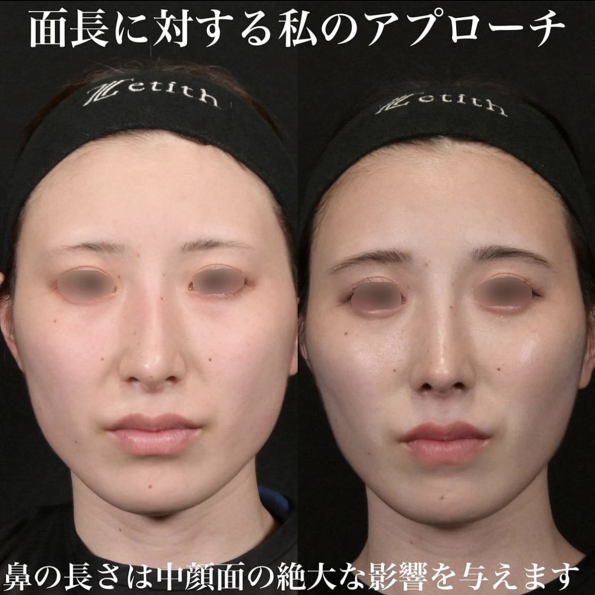 鉄医師による鼻整形の施術前／施術後3ヶ月 术后 