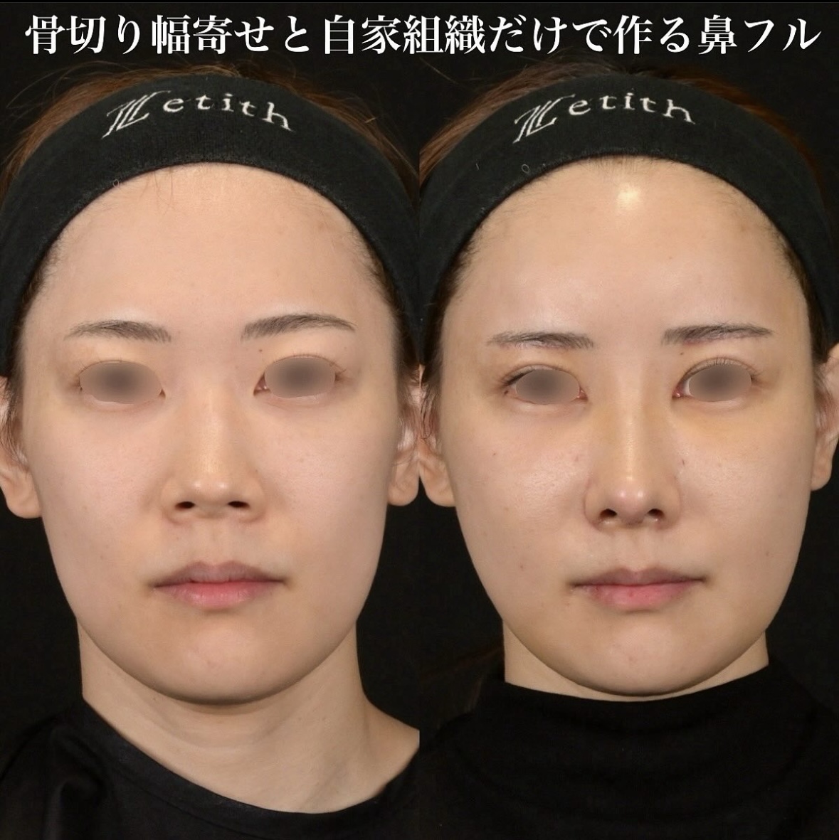 鉄医師による鼻整形の施術前／施術後1週間 Дараа 