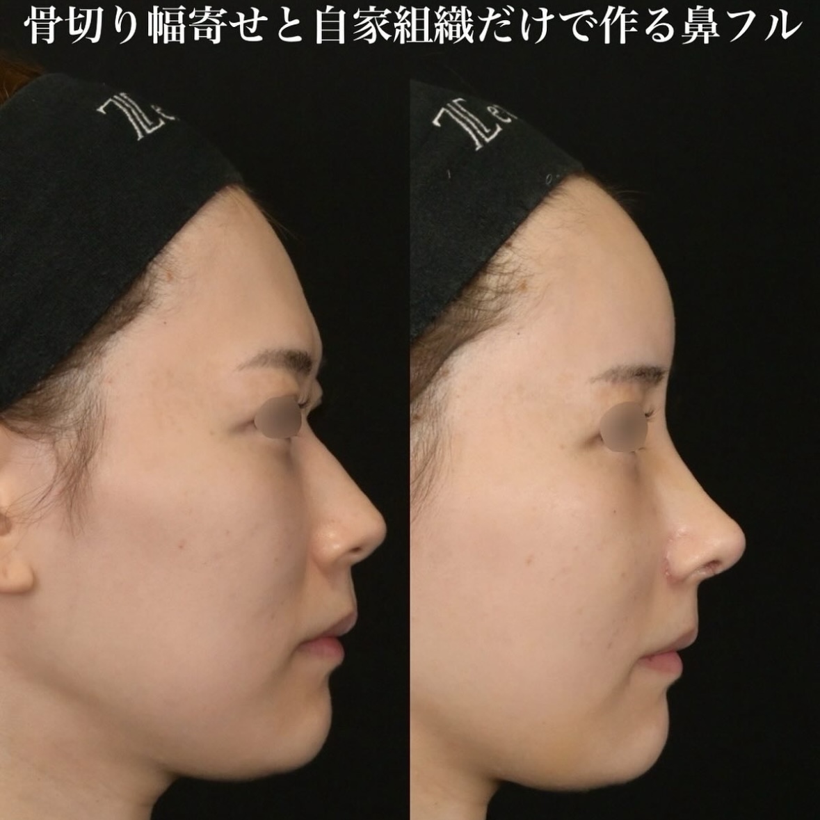 鉄医師による鼻整形の施術前／施術後1週間