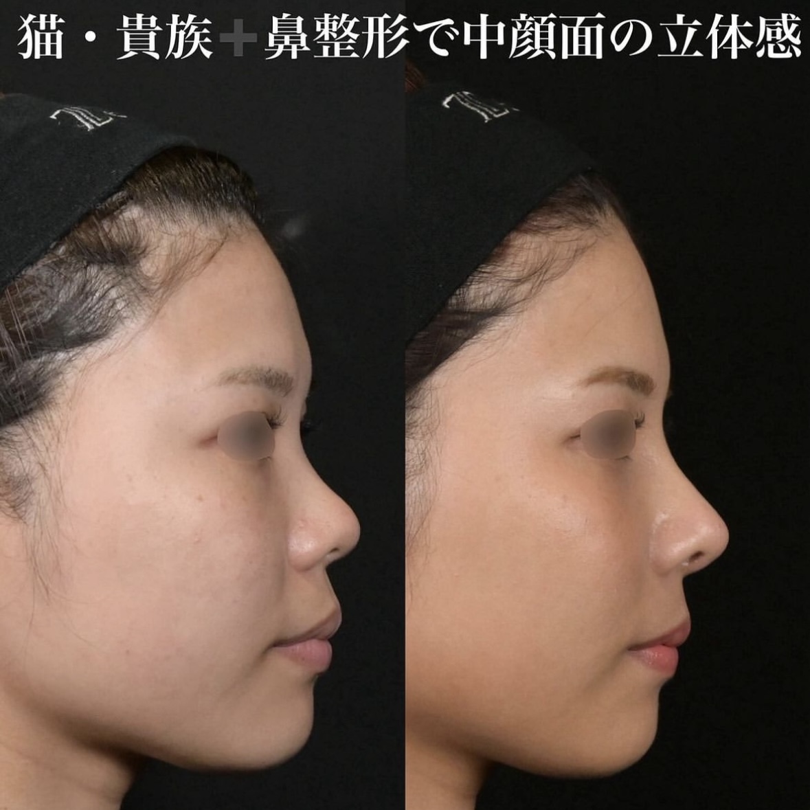 鉄医師による鼻整形の施術前／施術後3ヶ月