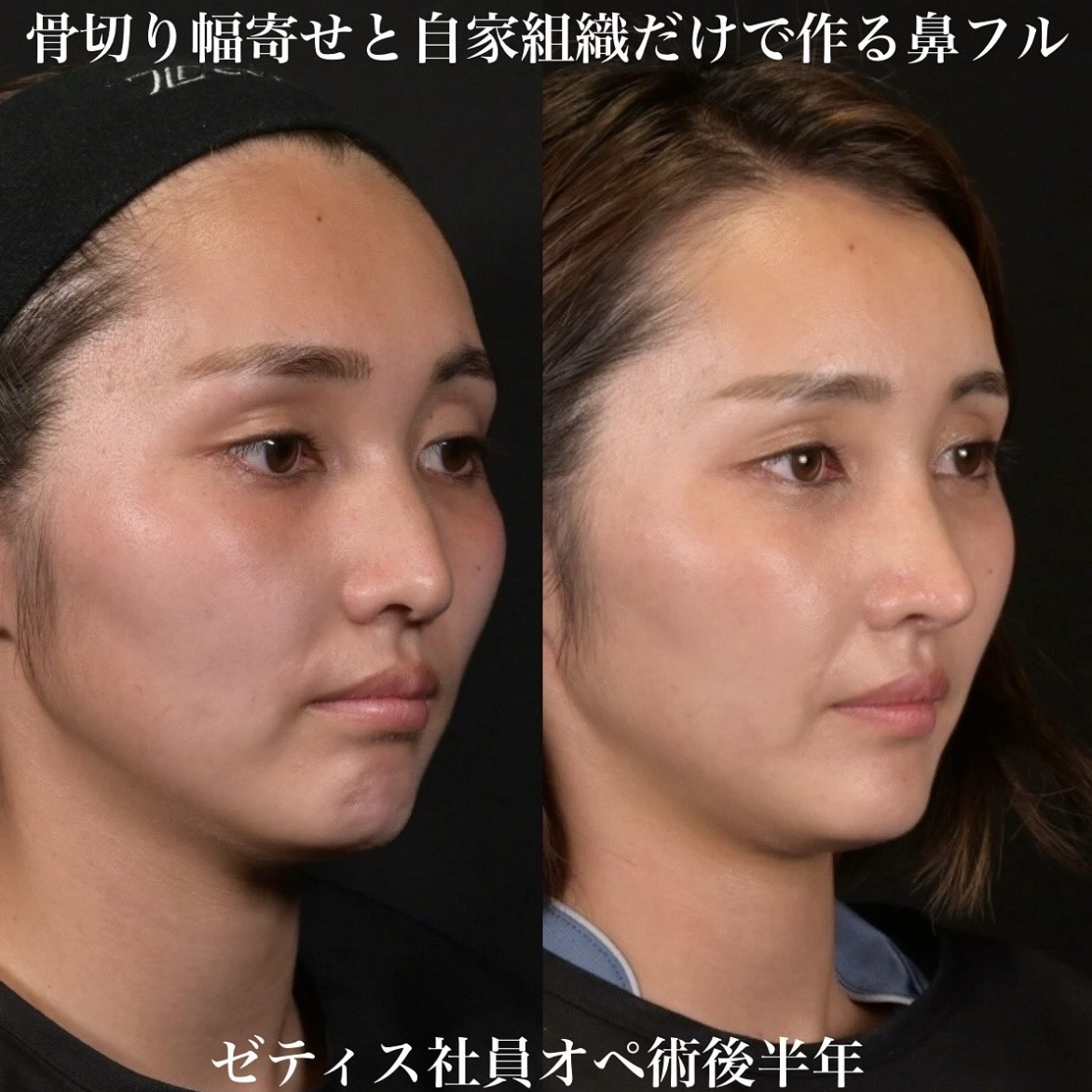 鉄医師による鼻整形の施術前／施術後6ヶ月