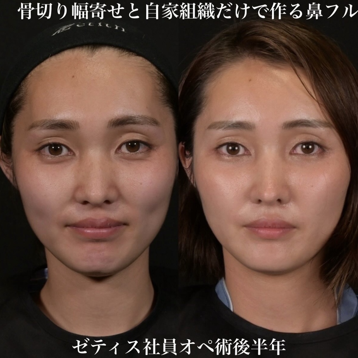 鉄医師による鼻整形の施術前／施術後6ヶ月 术后 