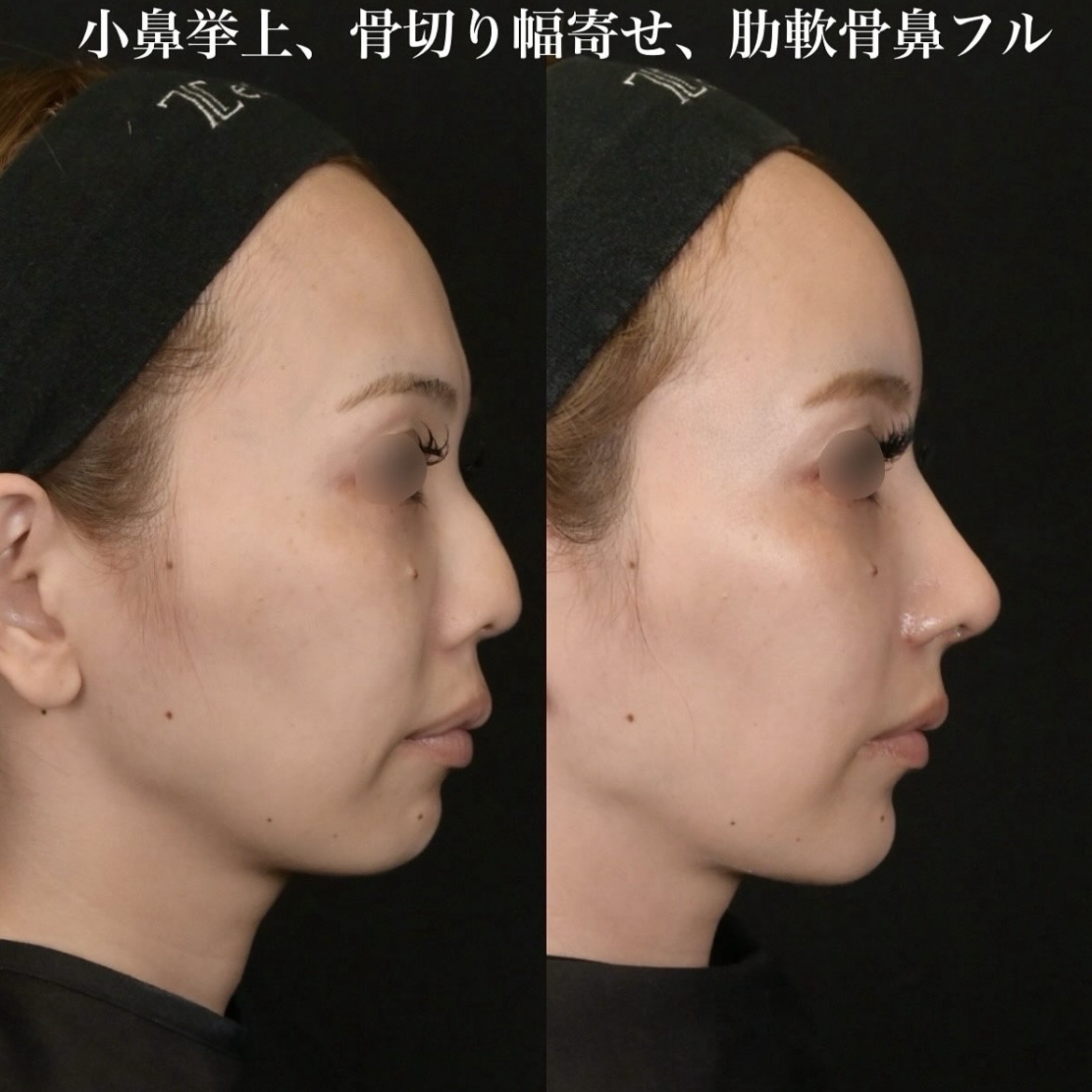 鉄医師による鼻整形の施術前／施術後1ヶ月