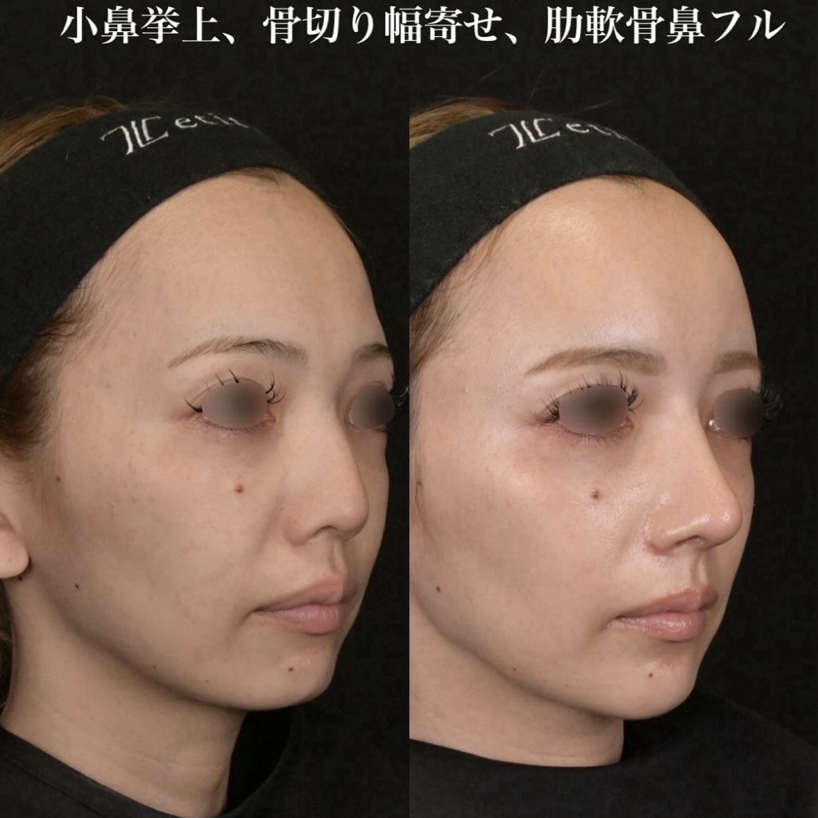 鉄医師による鼻整形の施術前／施術後1ヶ月 Sonra 